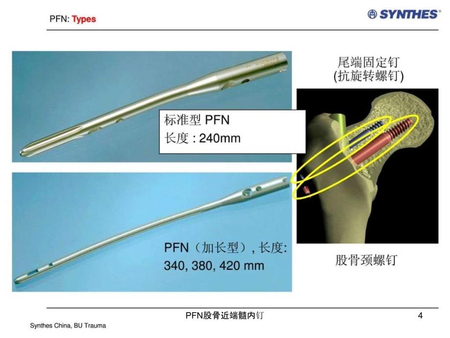 PFN股骨近端髓内钉课件_第4页