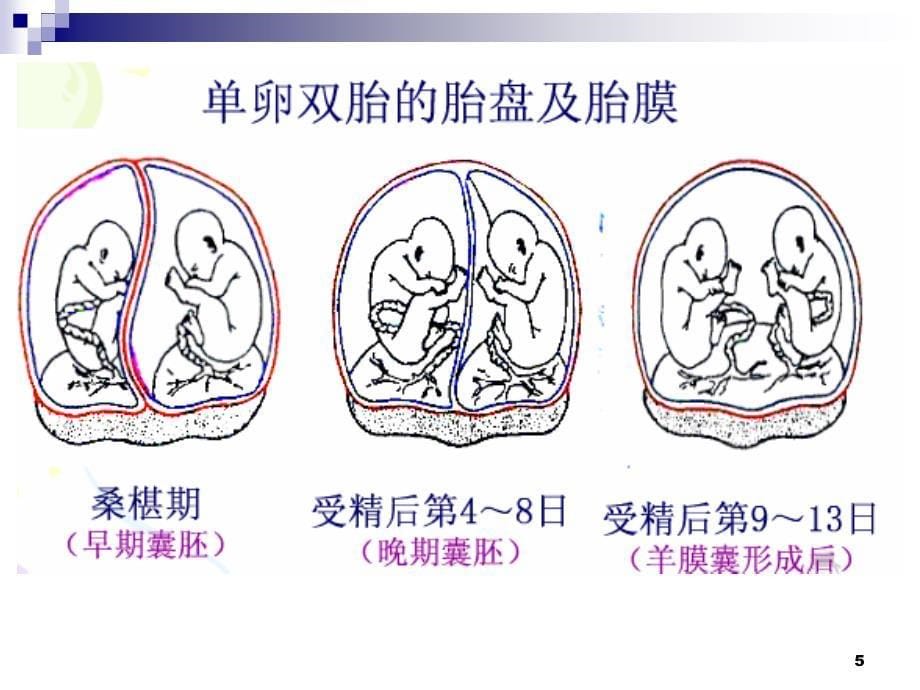 双胎妊娠膜性诊断与双胎特有并发症课堂PPT_第5页