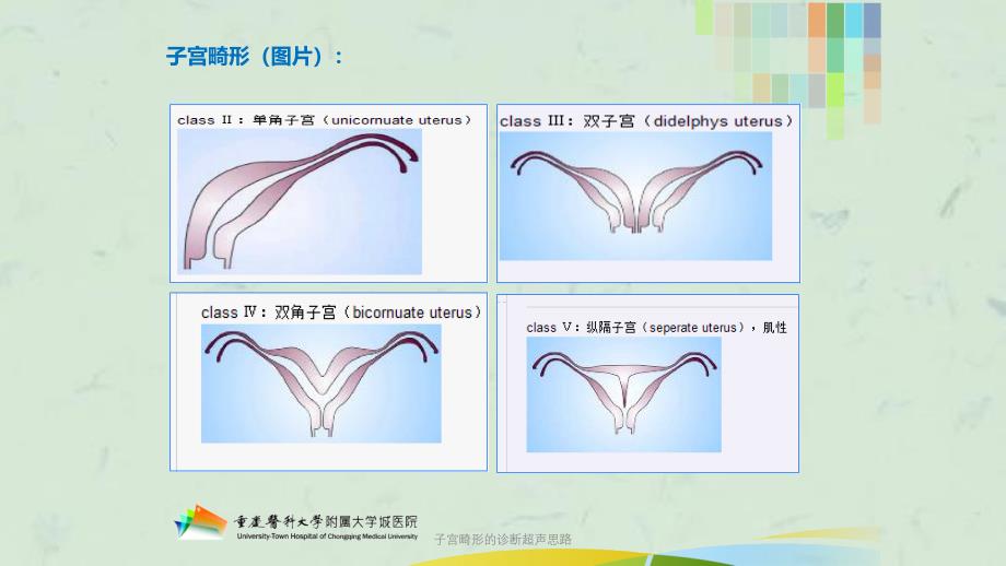 子宫畸形的诊断超声思路课件_第4页