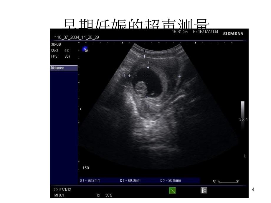 B超正常胎儿测量课件文档资料_第4页