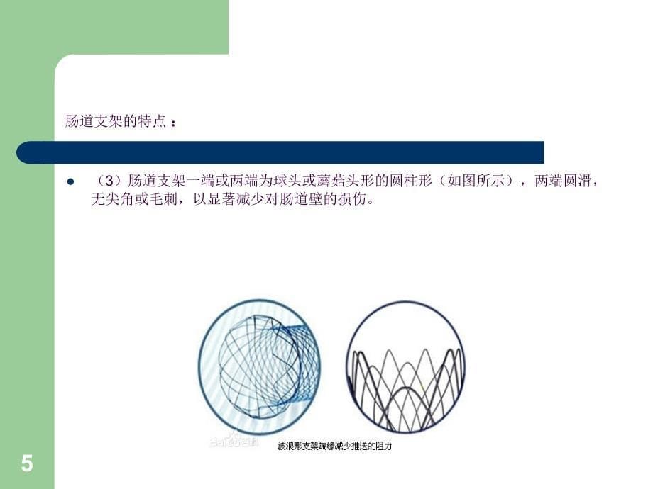 肠道支架植入术ppt课件_第5页