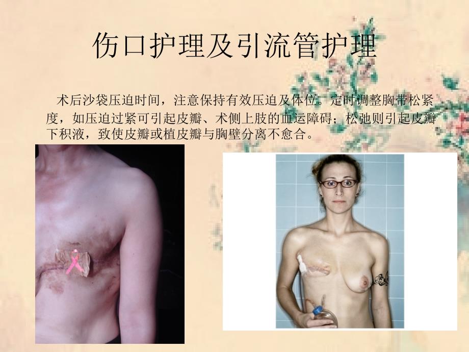 乳腺癌患者术后护理_第4页