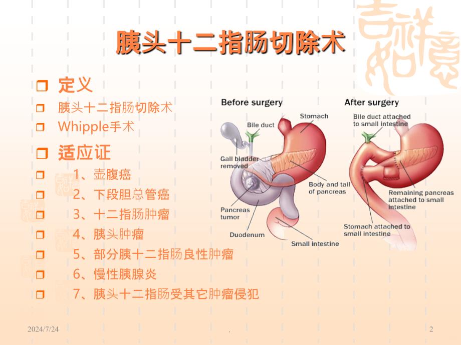 胰十二指肠切除术PPT课件1_第2页