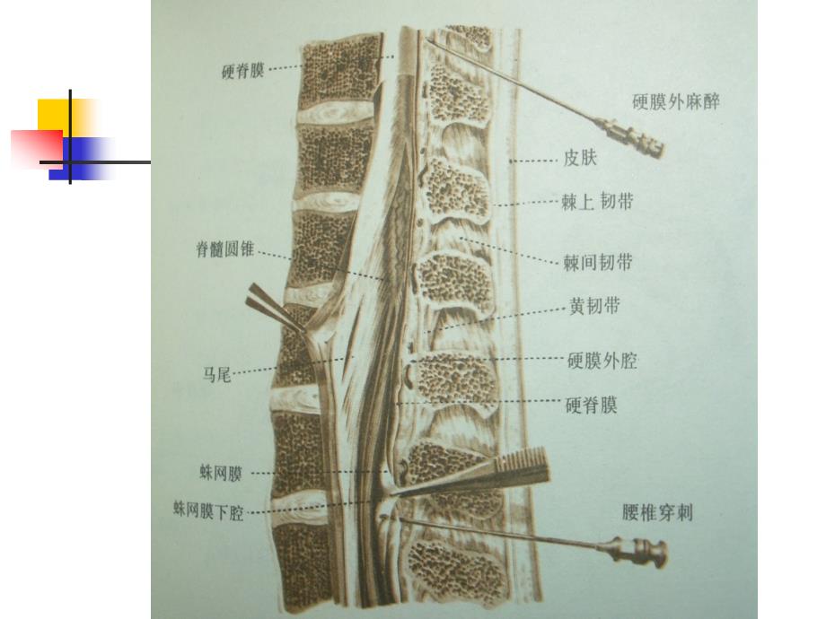 椎间盘突出的CT诊断_第3页