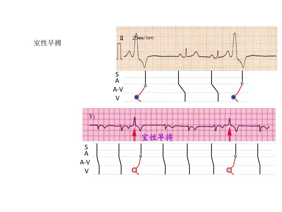 室性早搏的定位诊断与鉴别PPT课件02_第3页