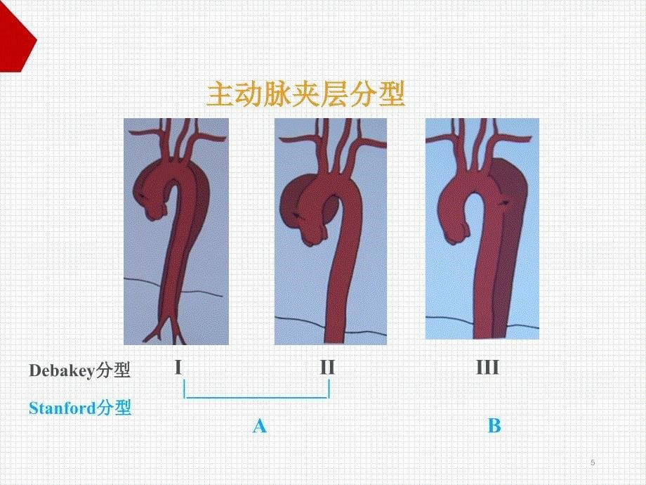 主动脉夹层的急救和转运中处理ppt课件_第5页