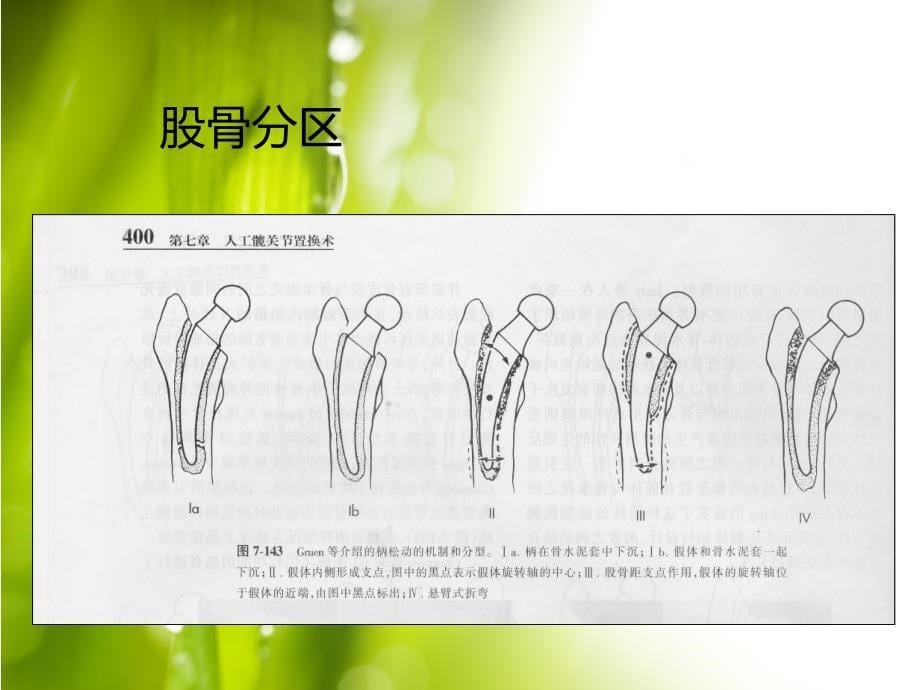 股骨与髋臼分区_第5页