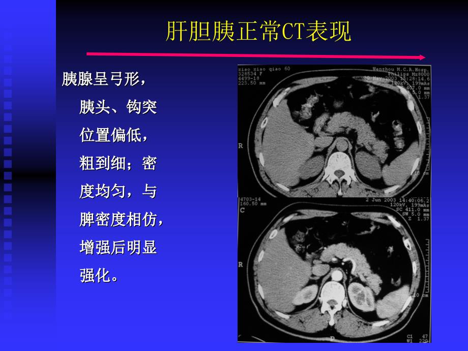 影像诊断学课件：影像系-胰脾及腹膜腔_第4页