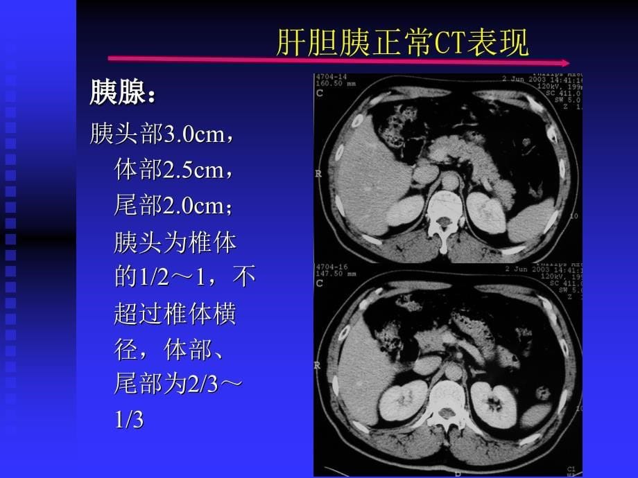 影像诊断学课件：影像系-胰脾及腹膜腔_第5页