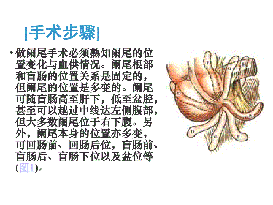 阑尾切除图解_第4页