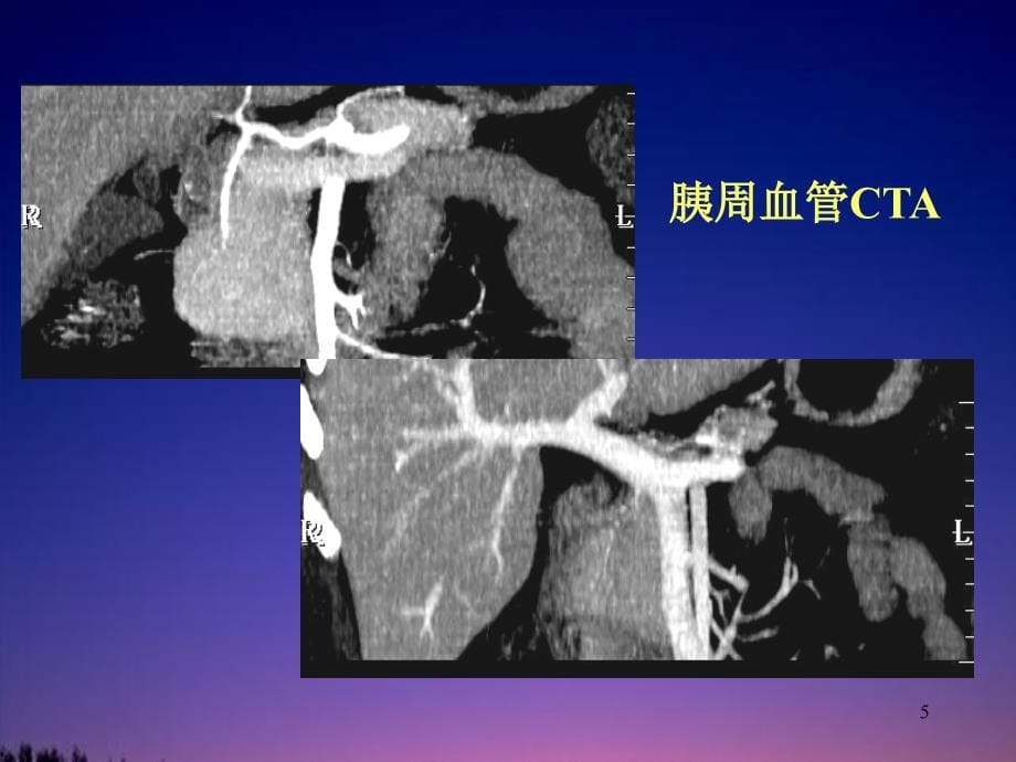 磁共振胰胆管造影MRCP_第5页