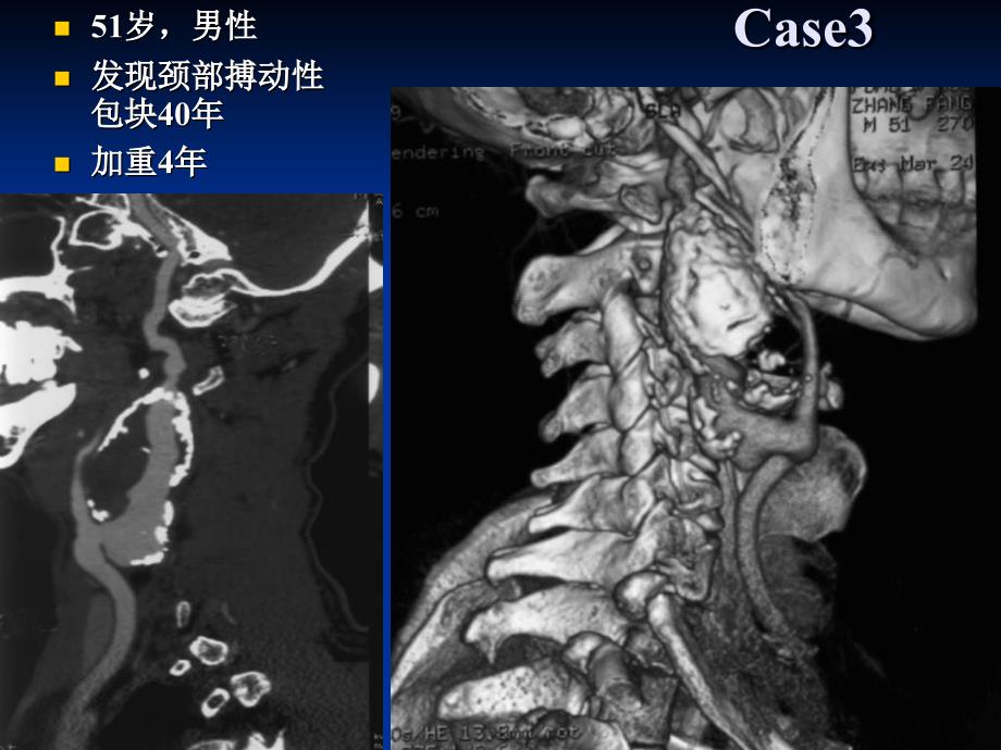 高位近颅侧颅底颈血管重建_第4页