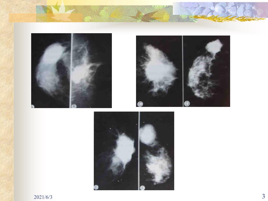 乳腺癌的X线影像学表现PPT优秀课件_第3页