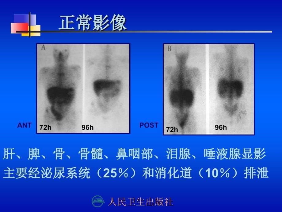 第十三章炎症显像_第5页