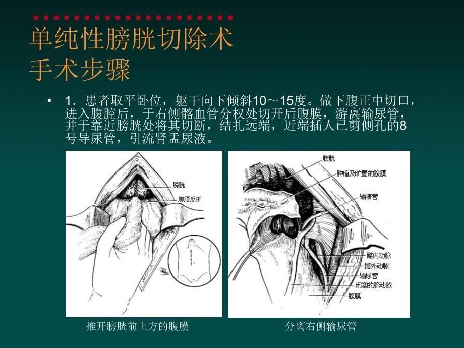 膀胱全切回肠代膀胱课件_第5页