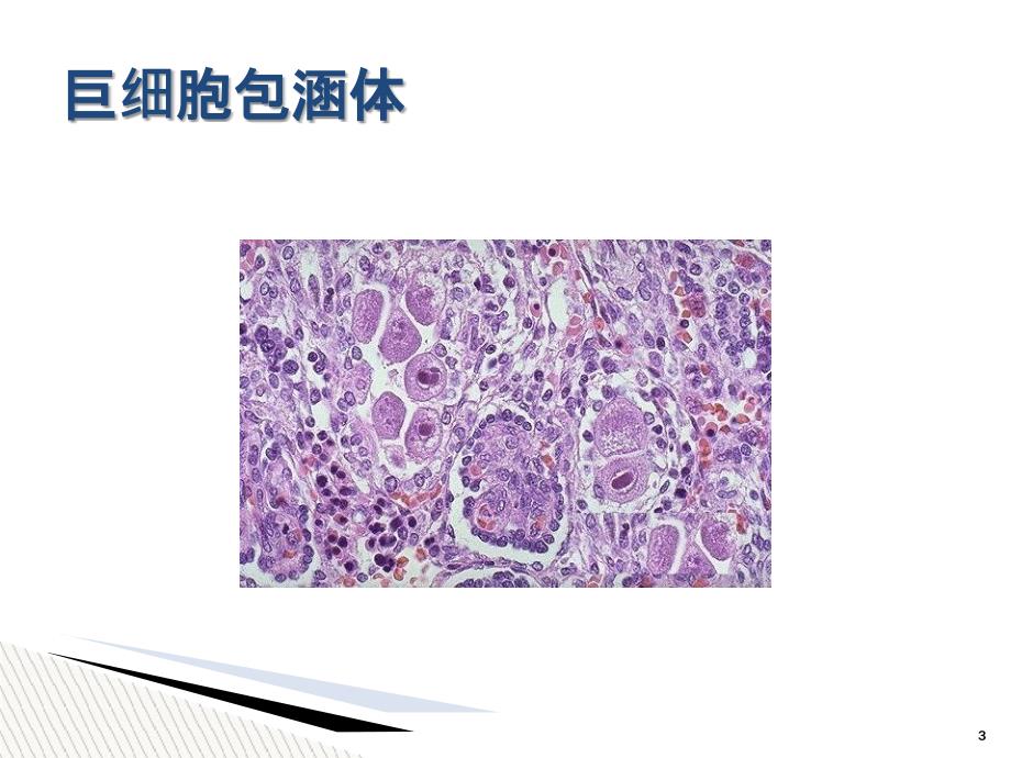 儿童巨细胞病毒性疾病诊断和防治_第3页