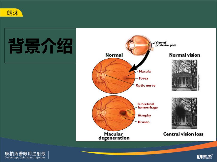 专家谈康柏西普ppt课件_第2页