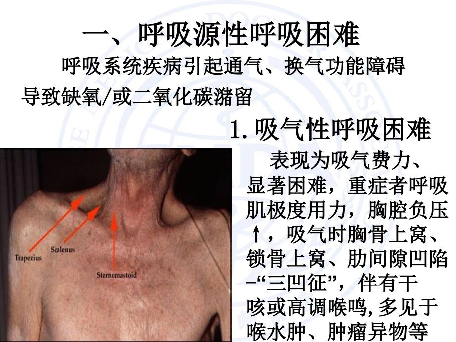 呼吸困难的急诊处理课件_第4页