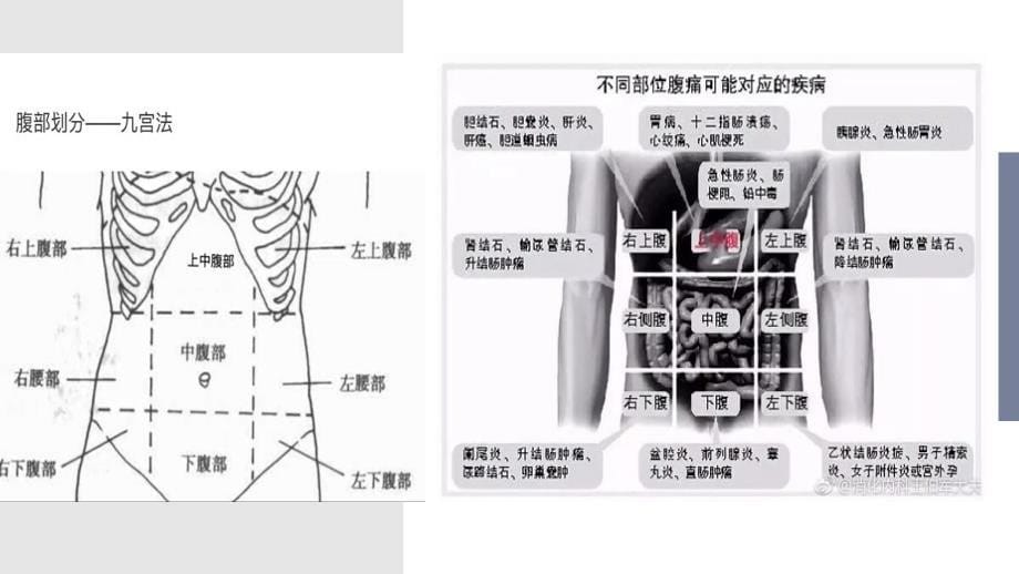 急腹症的诊断、鉴别诊断与诊断思路.ppt_第5页