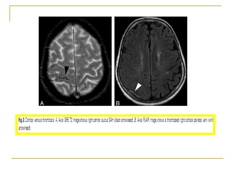 孤立性大脑凸面蛛网膜下腔出血病因_第5页