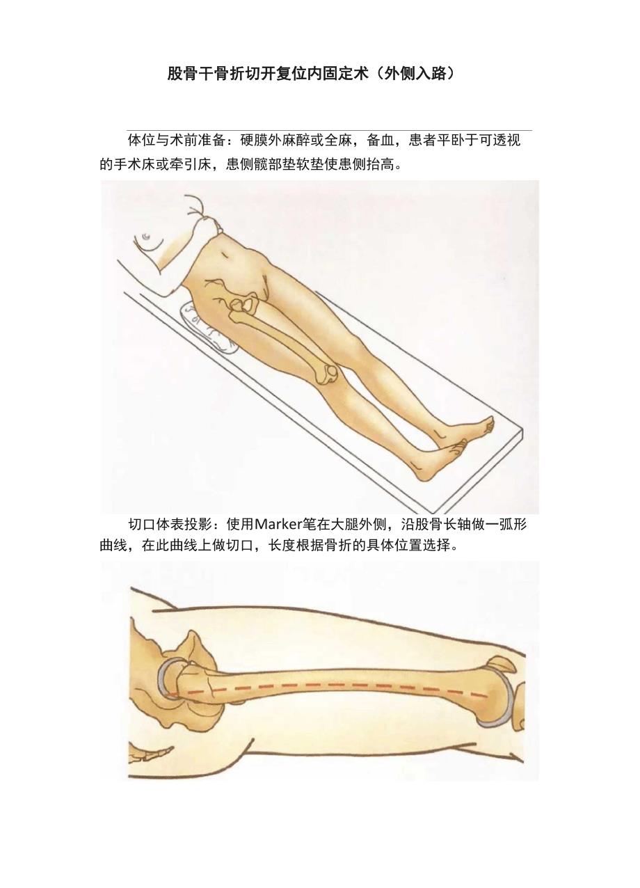 股骨干骨折切开复位内固定术_第1页