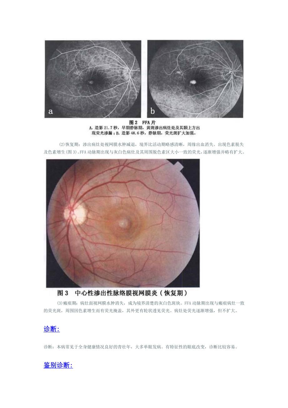 中心性渗出性脉络膜视网膜病变.doc_第3页