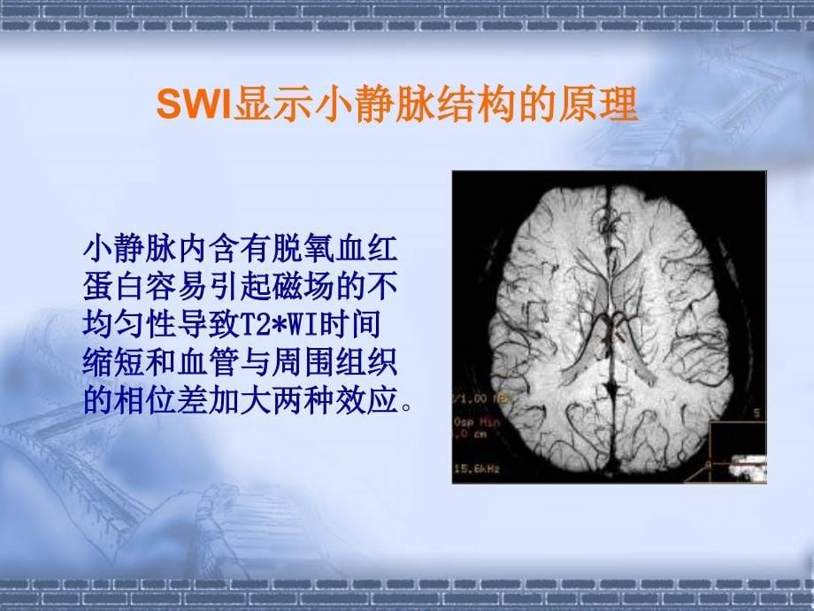 磁敏感加权成像SWI原理及临床应用_第5页