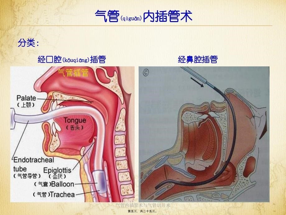 气管内插管术与气管切开术课件_第5页