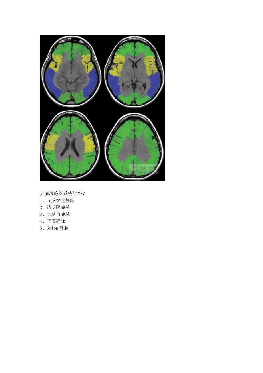 大脑的静脉系统MRV_第3页