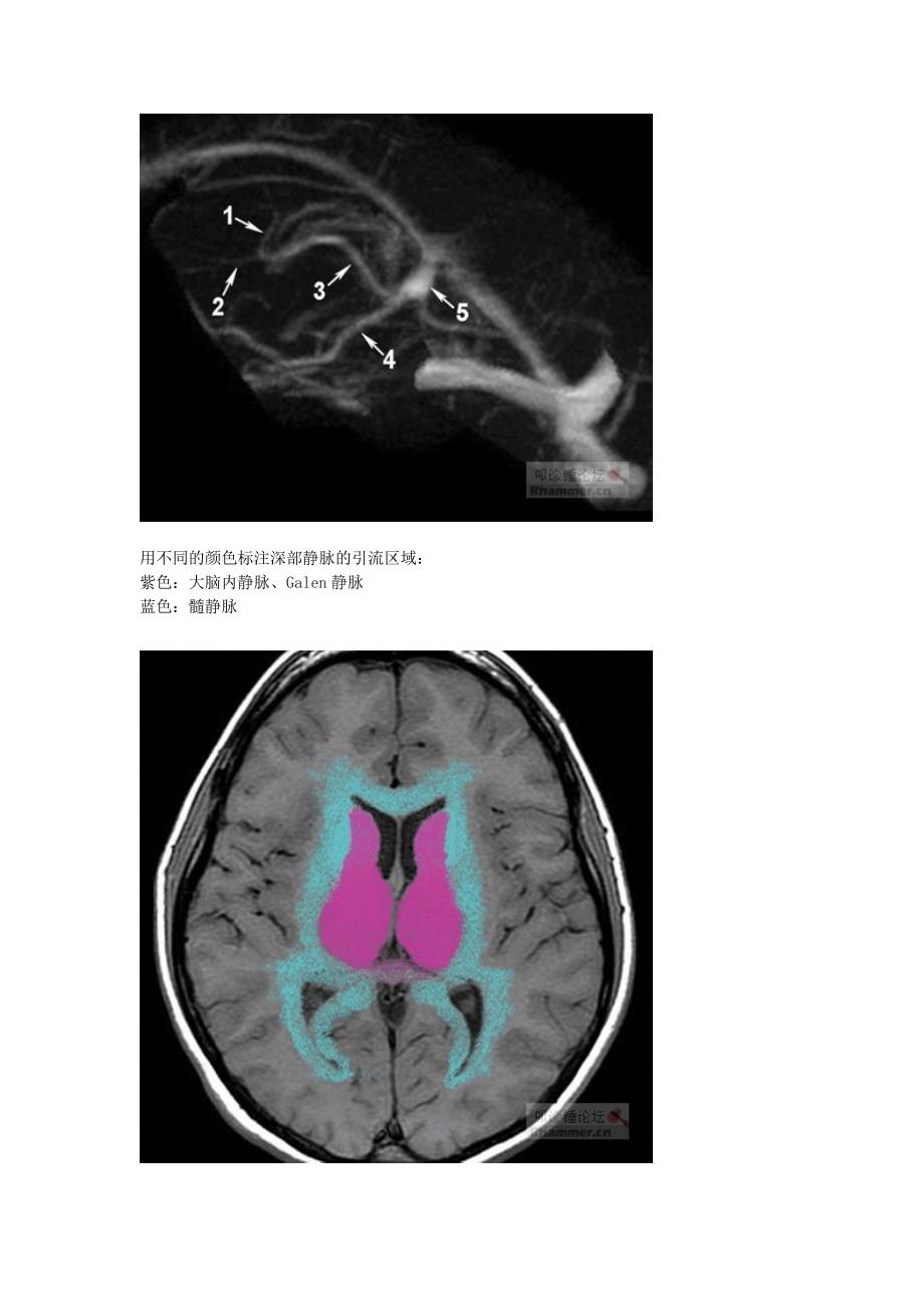 大脑的静脉系统MRV_第4页