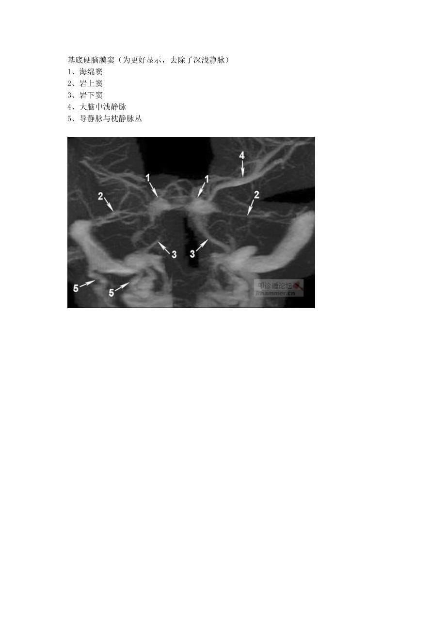 大脑的静脉系统MRV_第5页