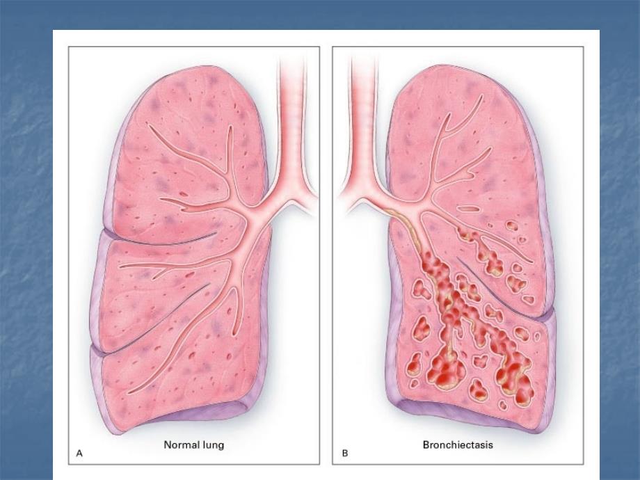 内科护理学 支气管扩张ppt课件_第4页