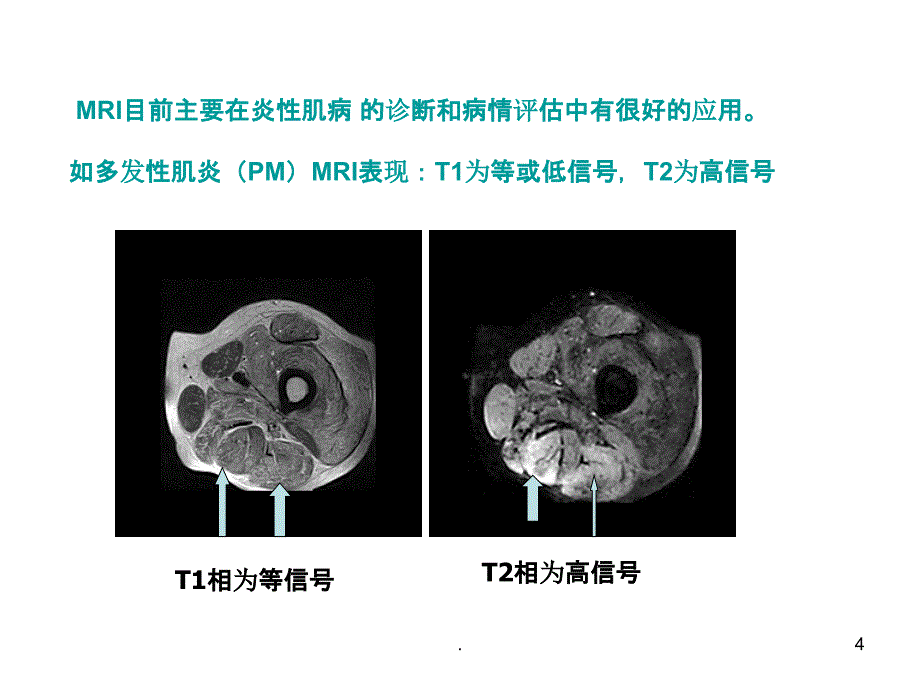 方琪遗传性肌肉疾病的诊断方法和策略PPT课件_第4页