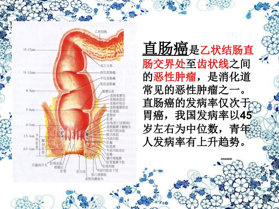 直肠癌及护理课件_第2页