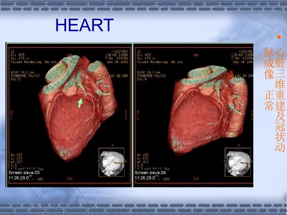 多层旋ct图片浏览ppt课件_第2页