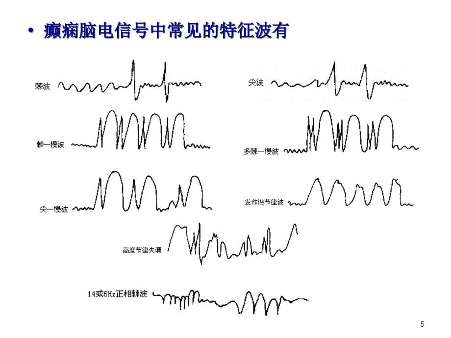 Ⅱ临床癫痫患者脑电信号近似熵分析25_第5页