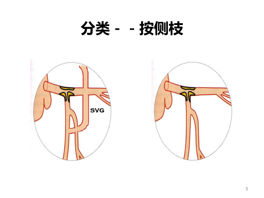 左主干病变的介入治疗ppt课件_第5页