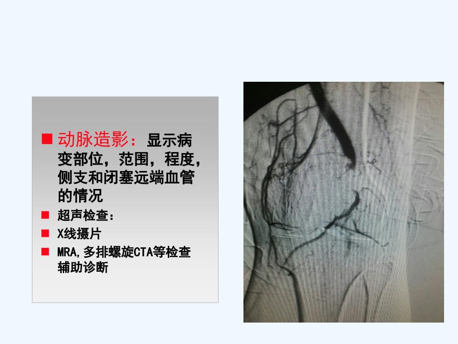 下肢动脉置管溶栓护理要点课件_第4页