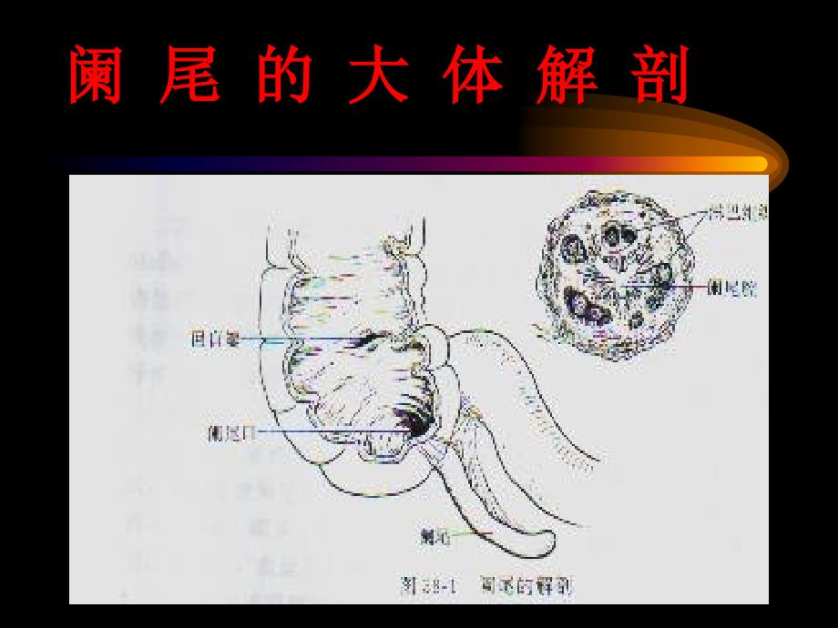 阑-尾-炎腹部教学幻灯课件_第1页