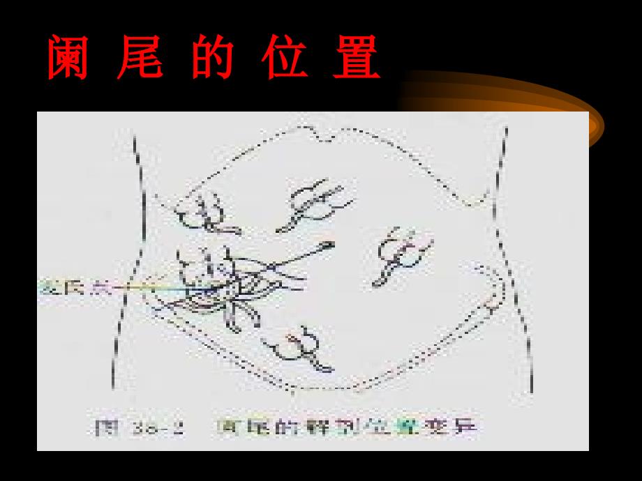 阑-尾-炎腹部教学幻灯课件_第2页