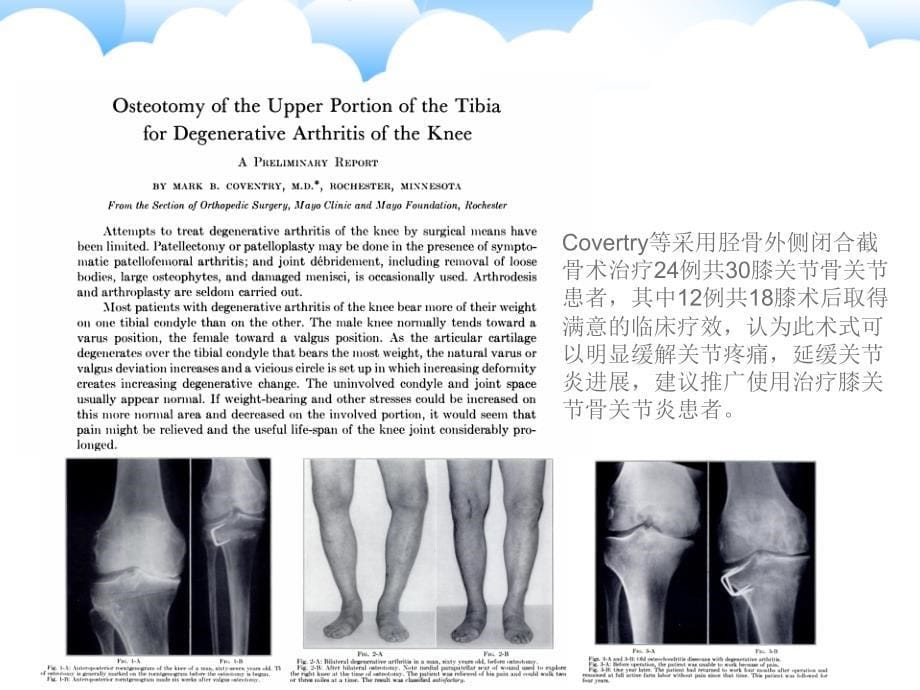 保膝治疗之1胫骨高位截骨术_第5页