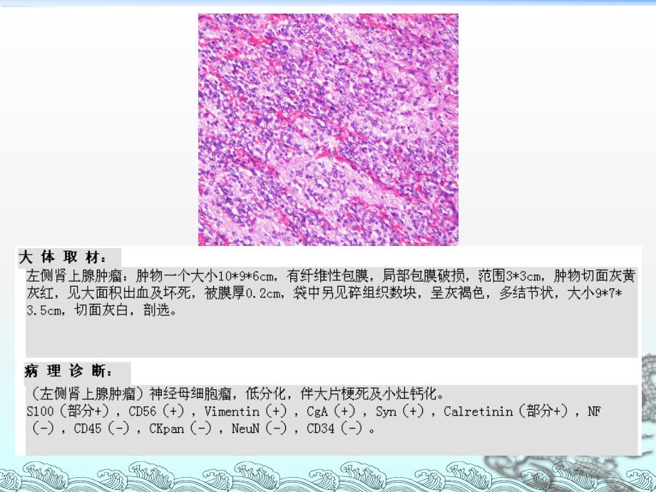 肾上腺神经母细胞瘤影像诊断与鉴别诊断ppt课件_第3页