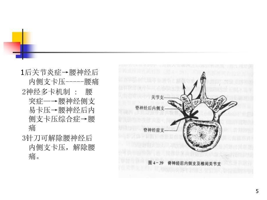 针刀治疗腰椎间盘突出症PPT课件_第5页