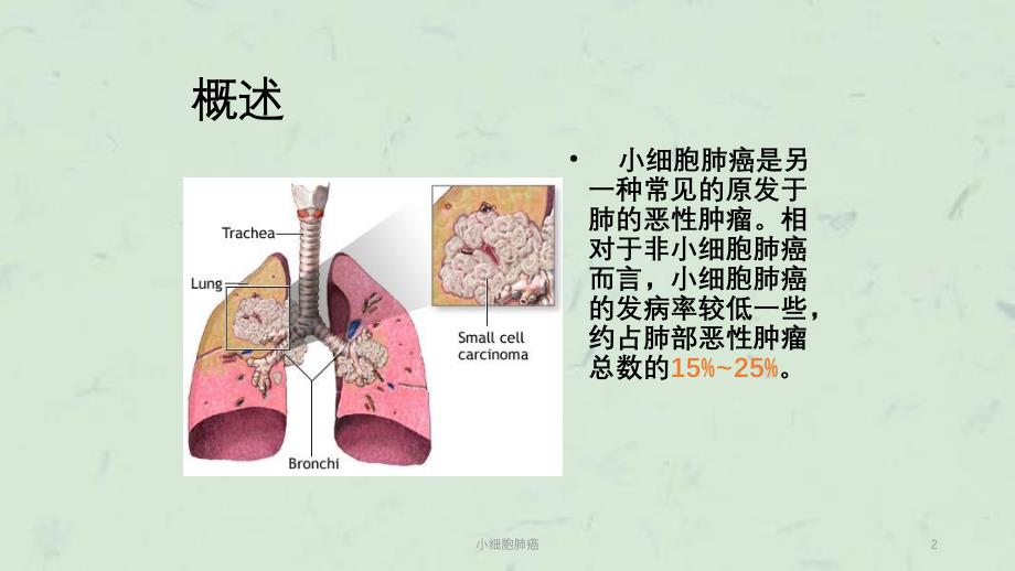 小细胞肺癌课件_第2页