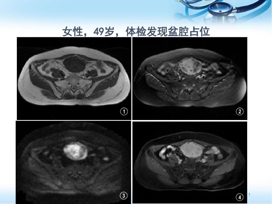 优质课件侵袭性纤维瘤病_第1页