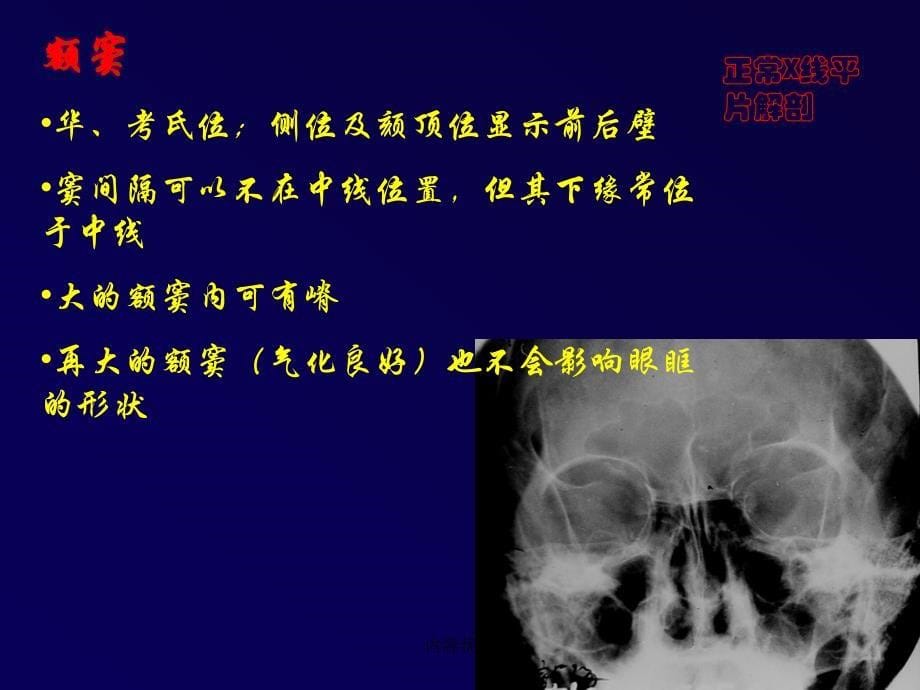 鼻和副鼻窦肿瘤影像诊断严选内容_第5页