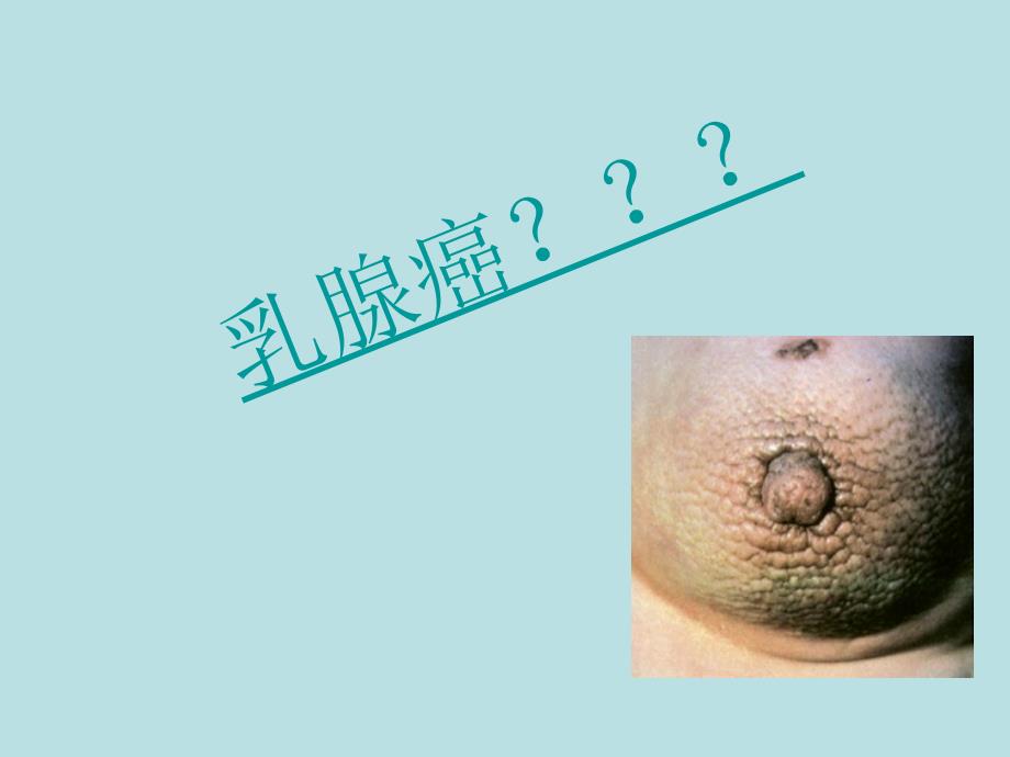 健康管理乳腺癌_第4页