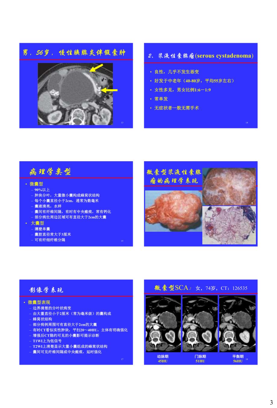 胰腺常见囊性病变的CT-MRI诊断杨正汉.pdf_第3页