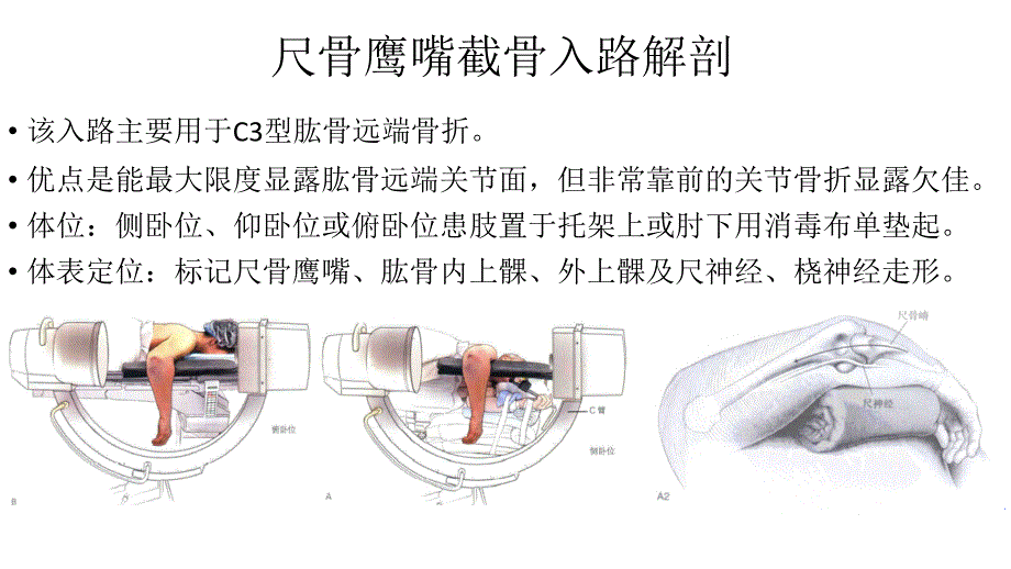 尺骨鹰嘴截骨入路解剖_第1页