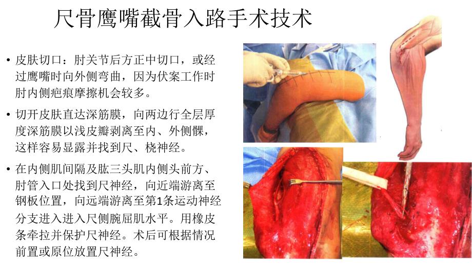 尺骨鹰嘴截骨入路解剖_第2页